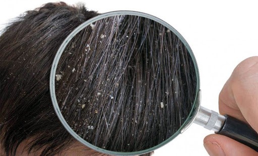 درمان ریزش مو با سرکه انگور